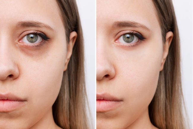 How Can I Get Rid of Dark Eye Circles