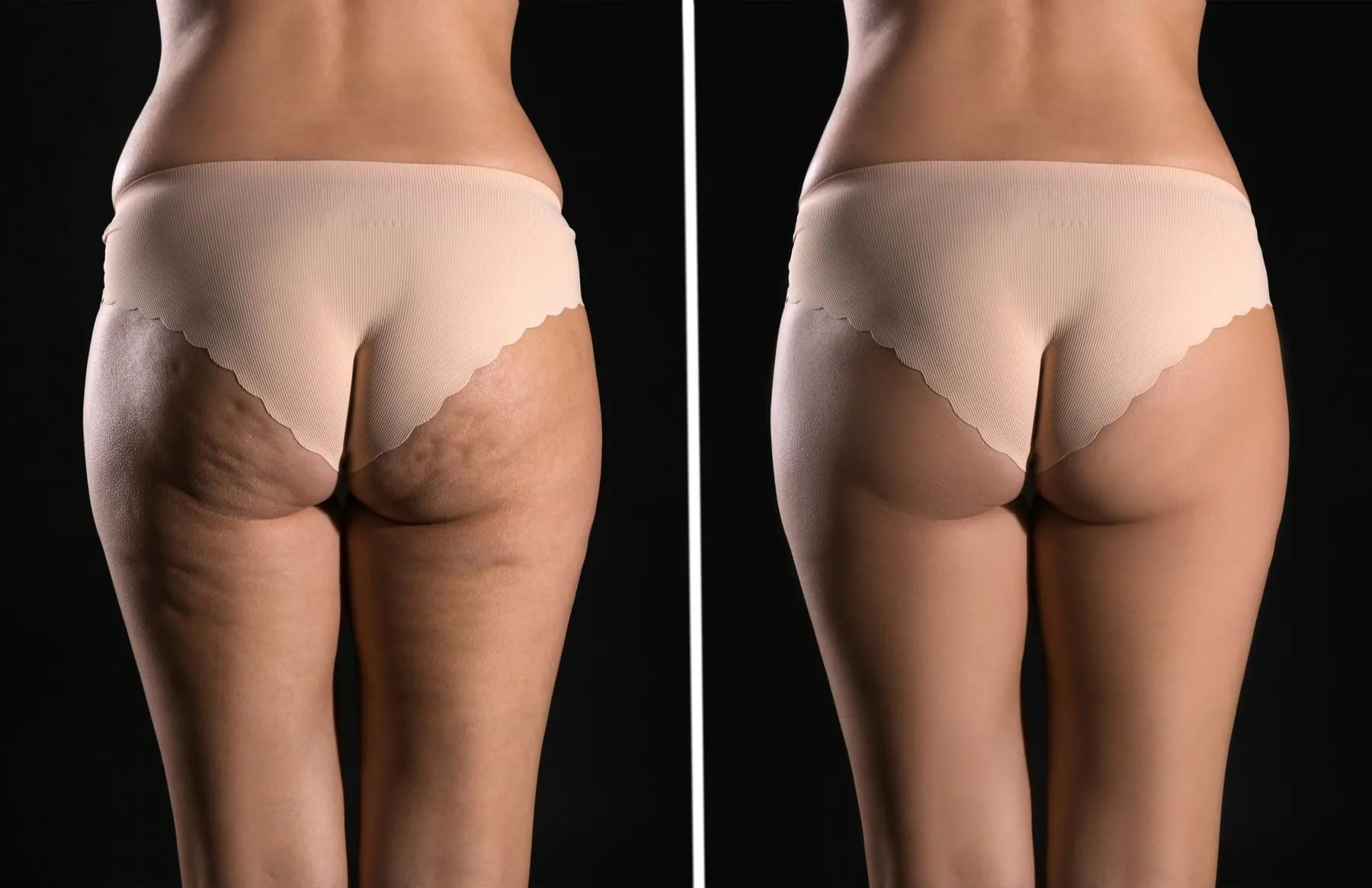 Qwo Cellulite Treatment