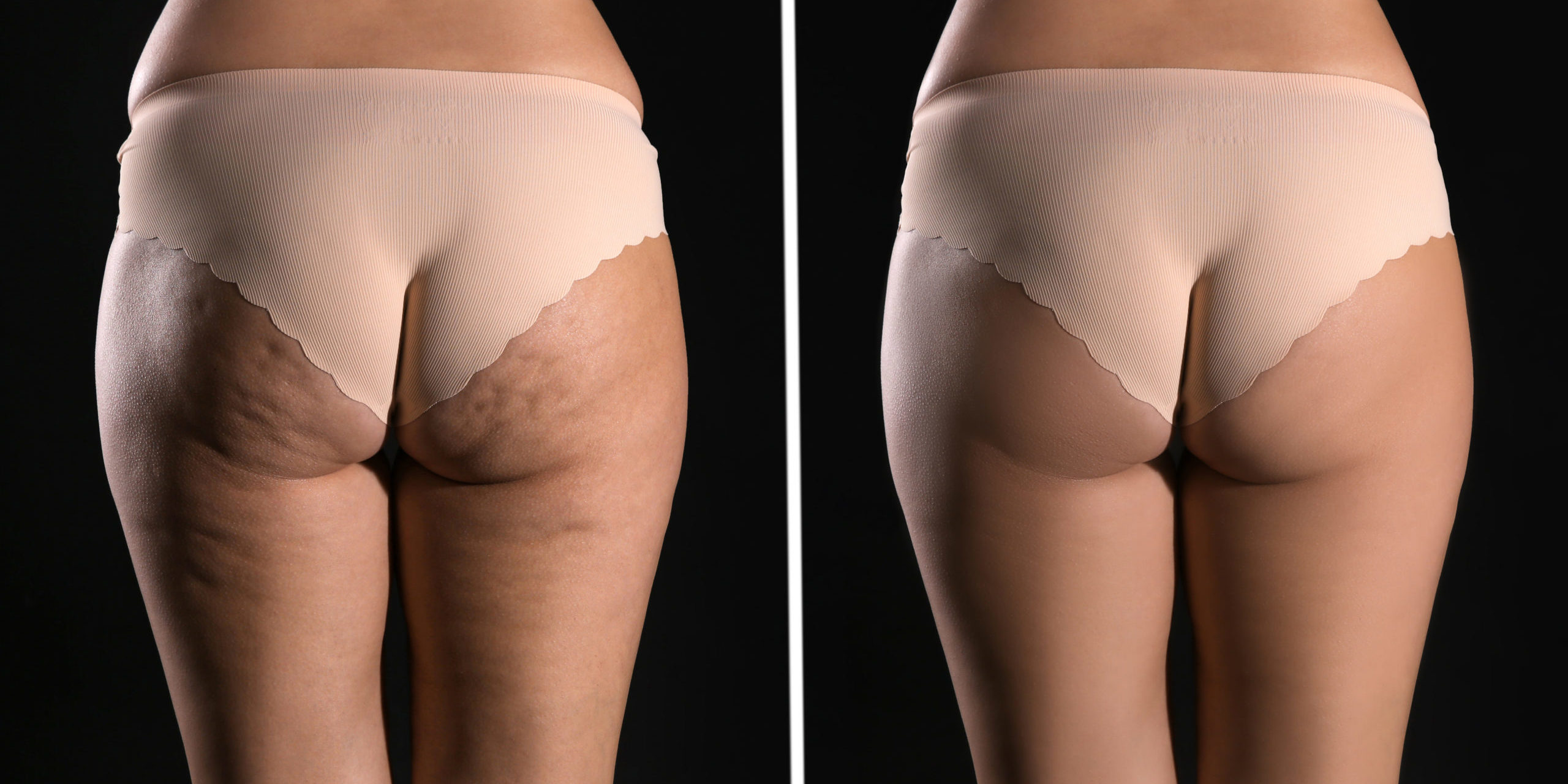 Qwo Cellulite Treatment - Facts & Controversies
