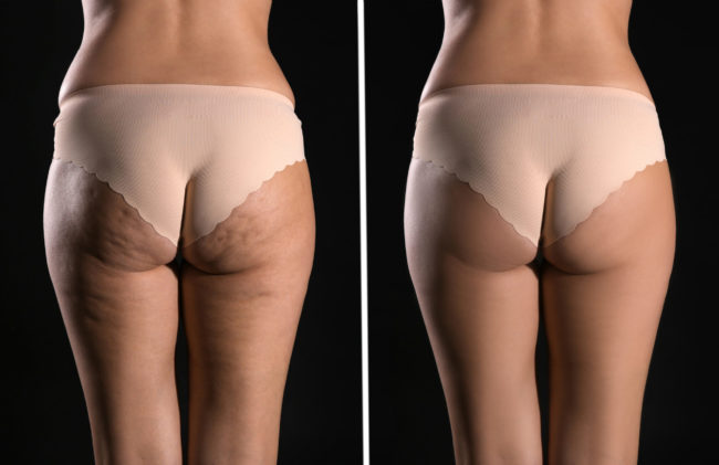 Qwo Cellulite Treatment