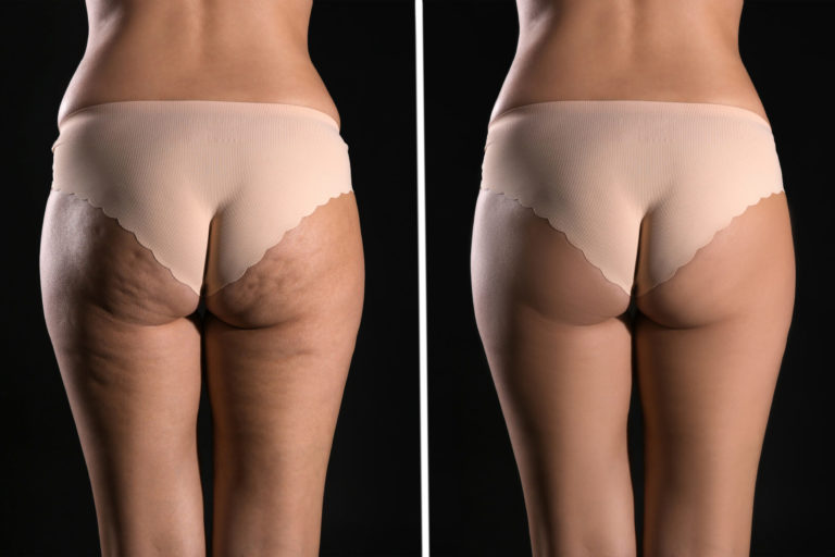 Qwo Cellulite Treatment