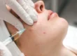 Adult Acne Facial in Abilene, TX
