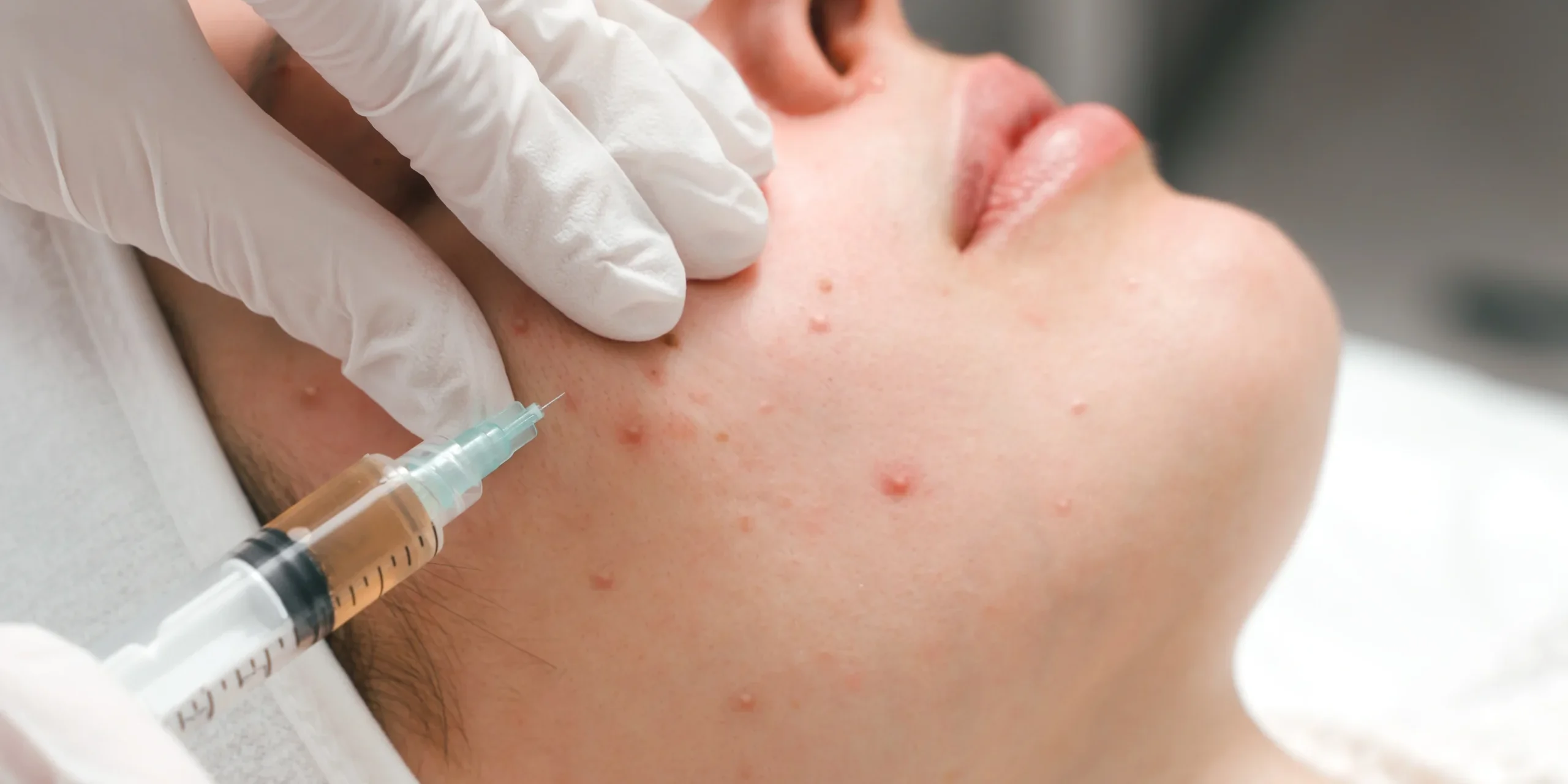 Adult Acne Facial in Abilene, TX