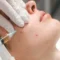 Adult Acne Facial in Abilene, TX