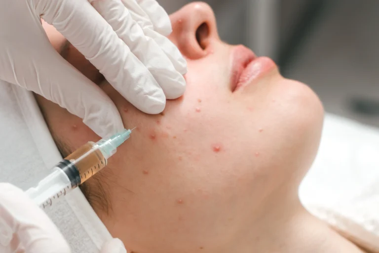 Adult Acne Facial in Abilene, TX