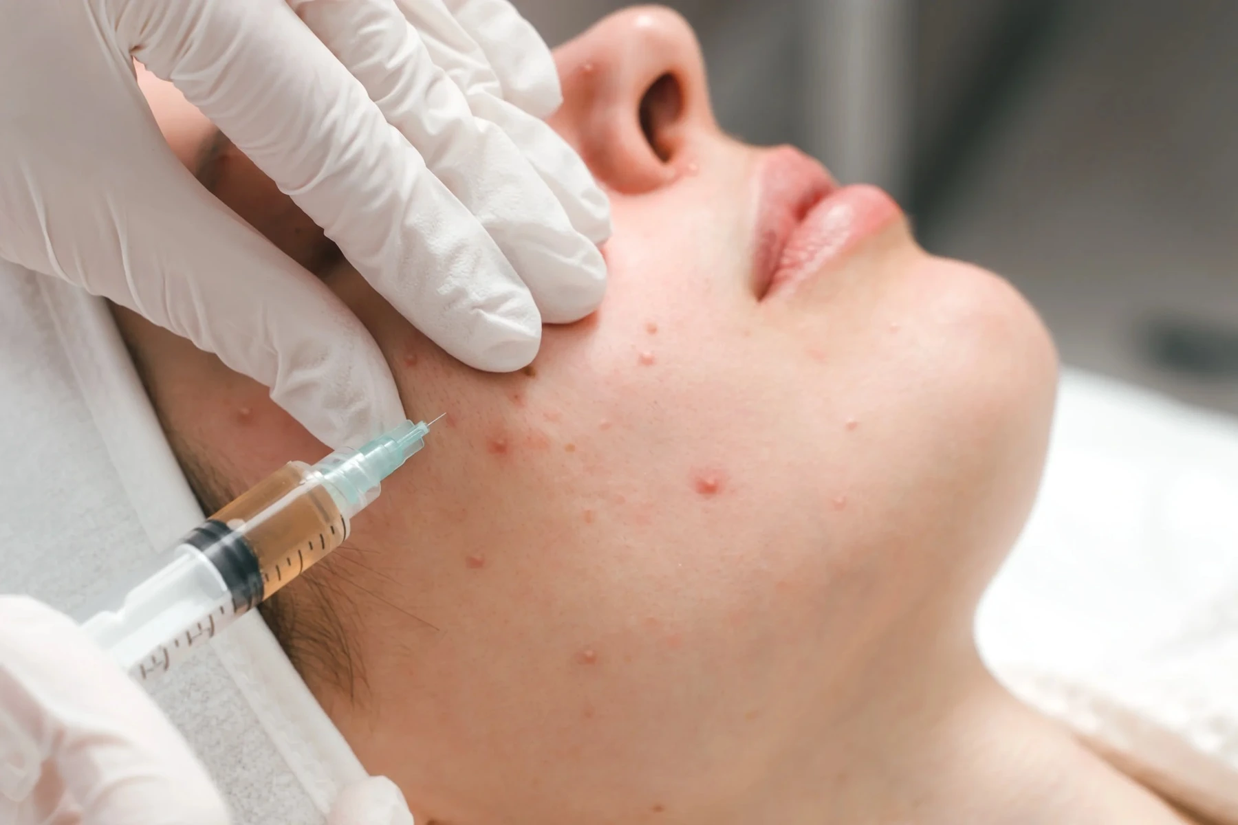 Adult Acne Facial in Abilene, TX