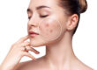 Adult Acne Facial in Abilene, TX