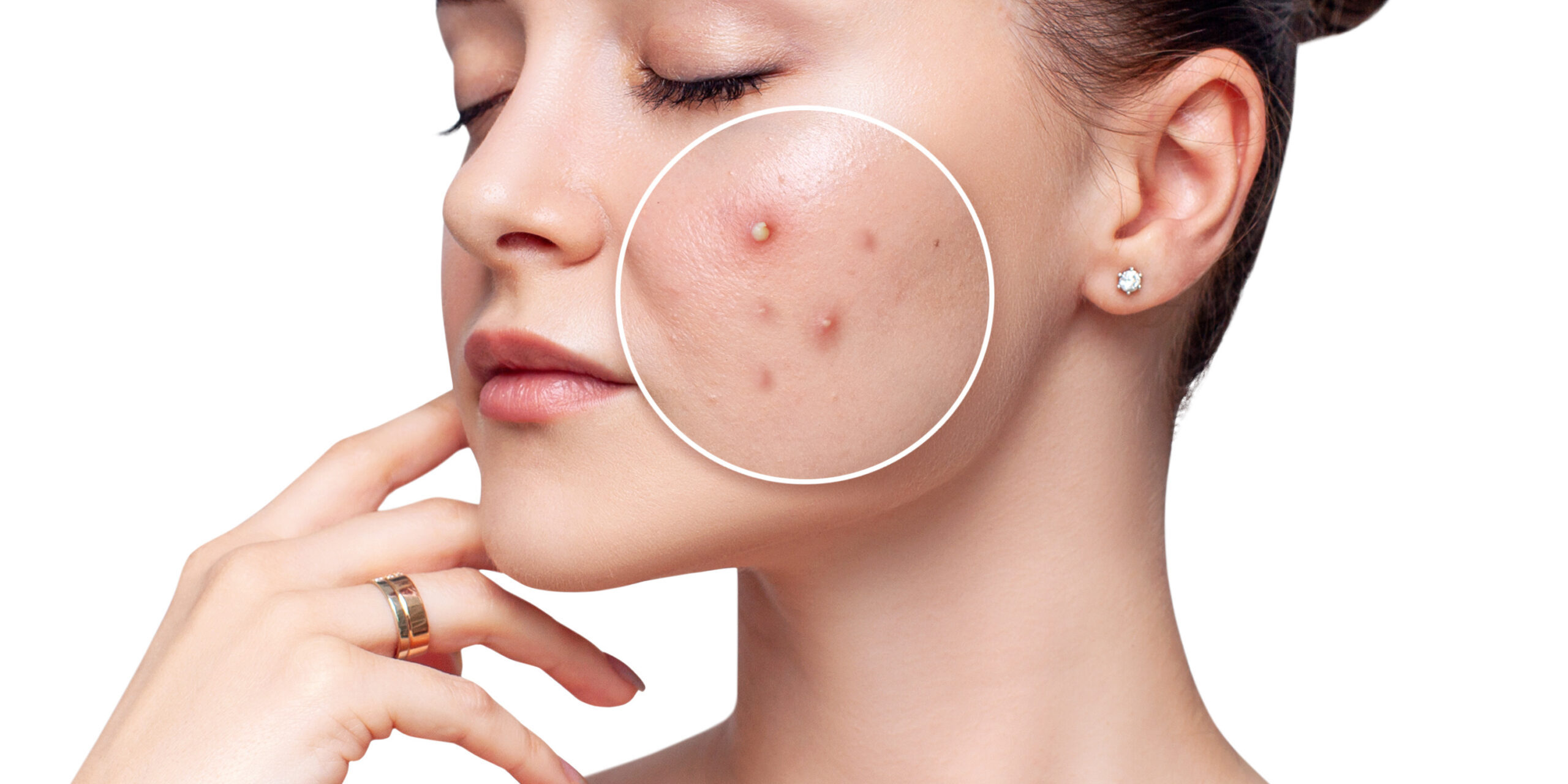 Adult Acne Facial in Abilene, TX