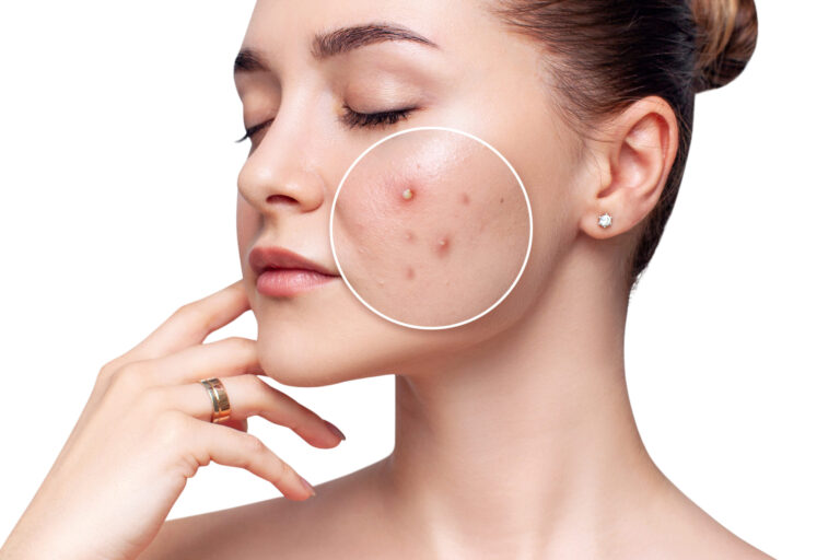 Adult Acne Facial in Abilene, TX