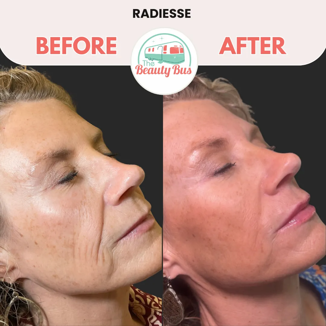 Radiesse-before-after-by-Abilene-Beauty-Bus-in-Abilene-TX