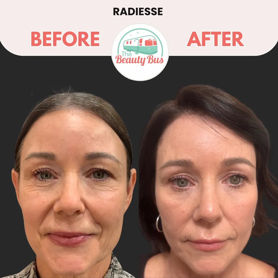 Radiesse-img-by-Abilene-Beauty-Bus-in-Abilene-TX