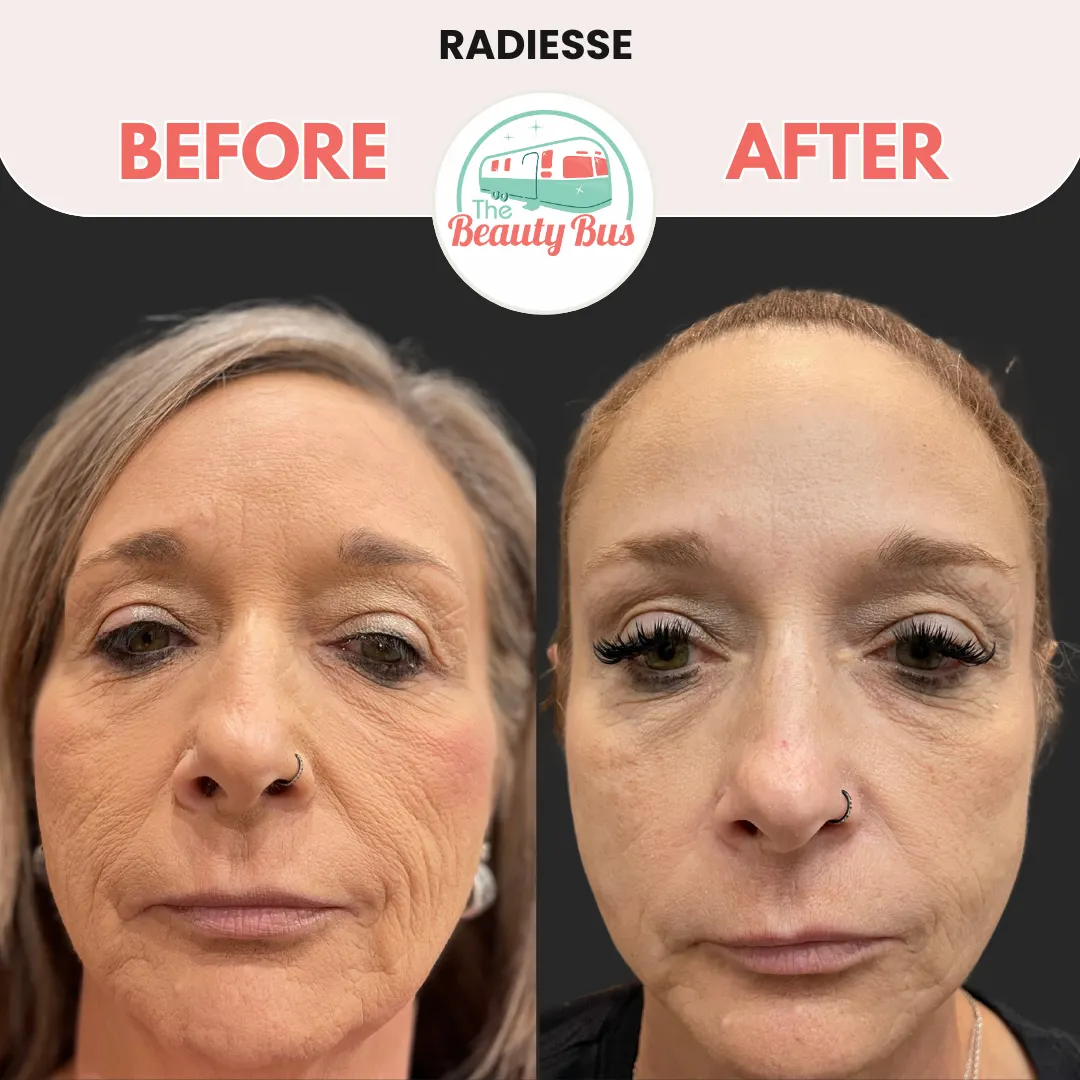 radiesse-ba-by-Abilene-Beauty-Bus-in-Abilene-TX