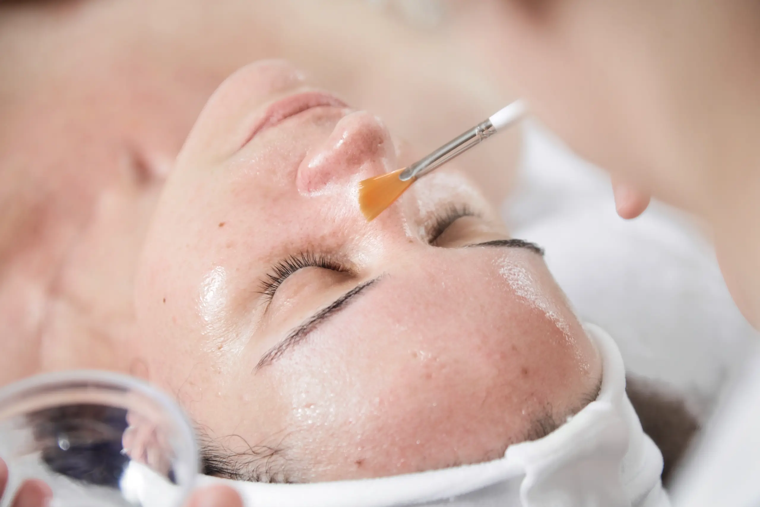 Laser Facial vs Chemical Peel Which Treatment Gives Better Skin Rejuvenation